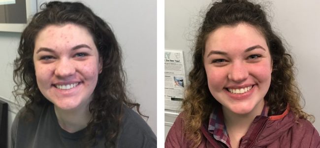 Acne treatment Duluth
