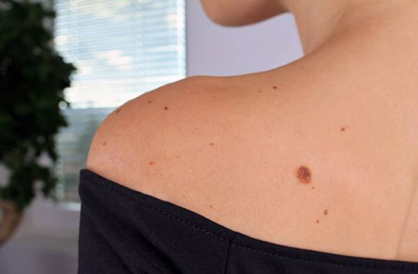 Basal and Squamous Cell Carcinoma Duluth