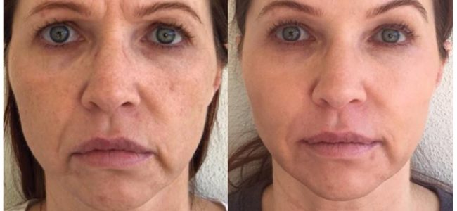 Botox Duluth