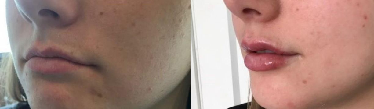 Dermal Filler Duluth