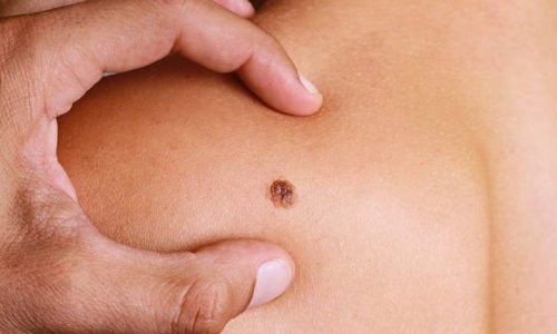 Duluth Basal and Squamous Cell Carcinoma