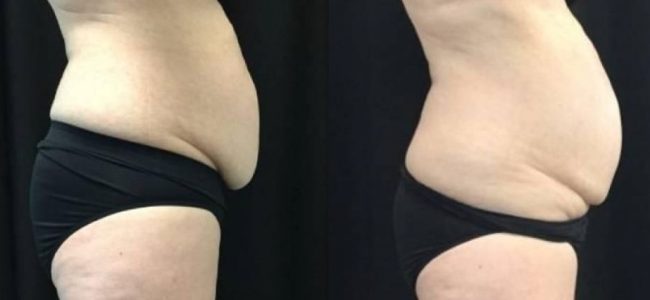 Duluth Coolsculpting