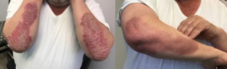 Duluth Xtrac Psoriasis Treatment