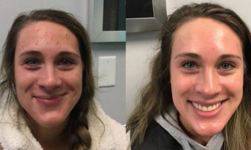 Laser Skin Resurfacing Duluth
