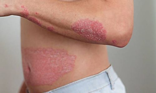 Psoriasis Duluth