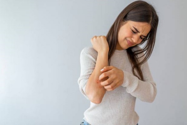 Psoriasis treatment Duluth