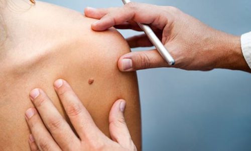 Skin Cancer Surgery Duluth