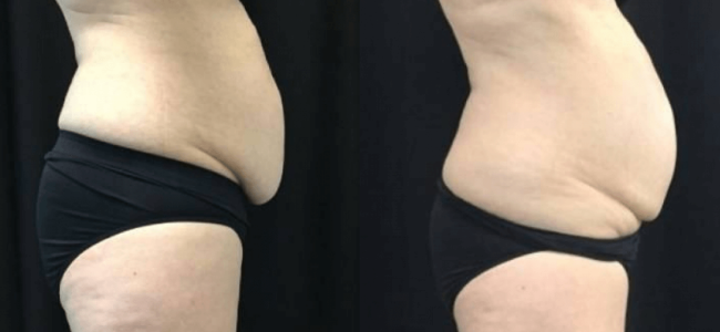 Coolsculpting Duluth